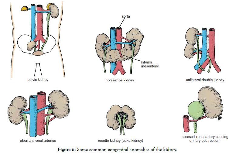 Congenital Anomalies Of Kidney And Urinary Tract CAKUT Literatu