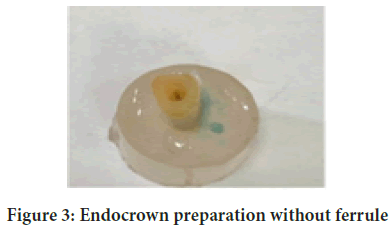 Endocrown