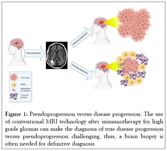 Pseudoprogression