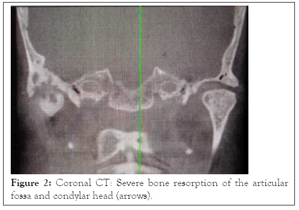 Management of Trismus Using a Mouth Gag with Expansion Screw and