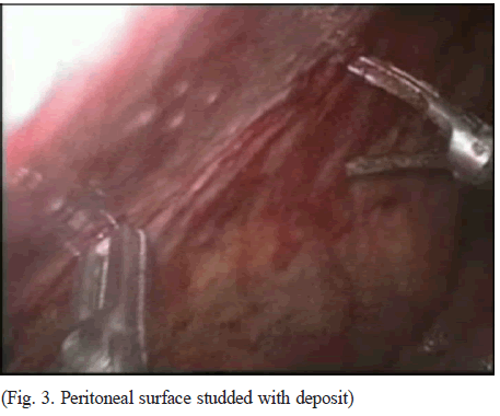 Peritoneal Metastases | Radiology Key