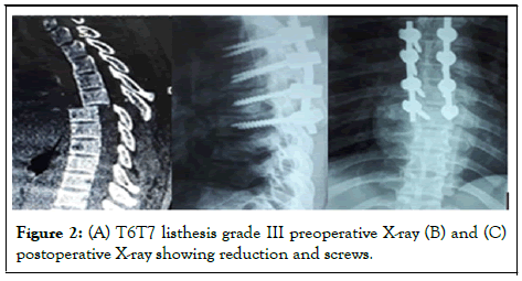 listhesis