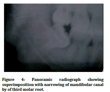 JRMDS-mandibular