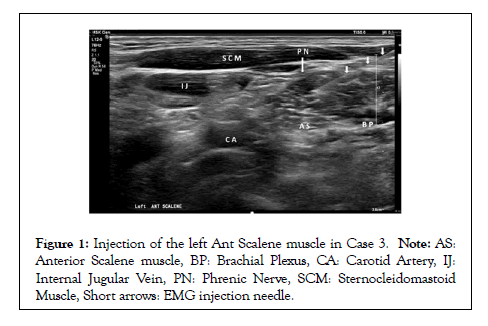 Physical-Medicine-needle