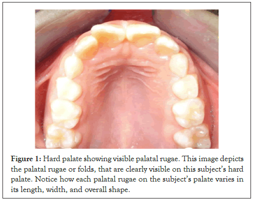 odontology-rugae-hard-palate