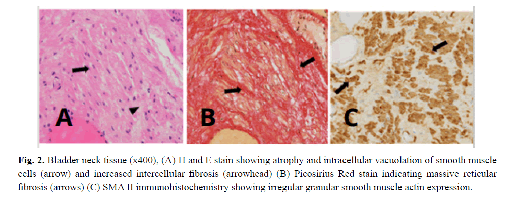 Irregular bladder smooth muscle actin-gamma 2 expression in ACTG2  mutation-associated Megacystis Microcolon Intestinal Hypoperistalsis  Syndrome (MMIHS): A case report
