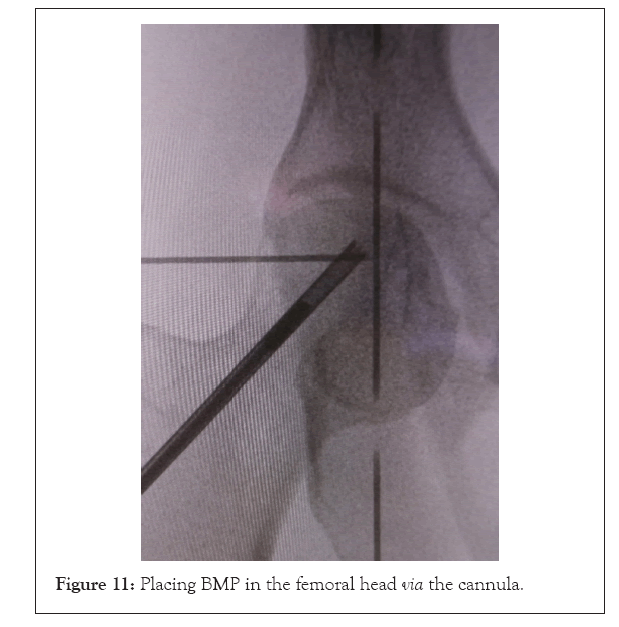 physical-medicine-femoral