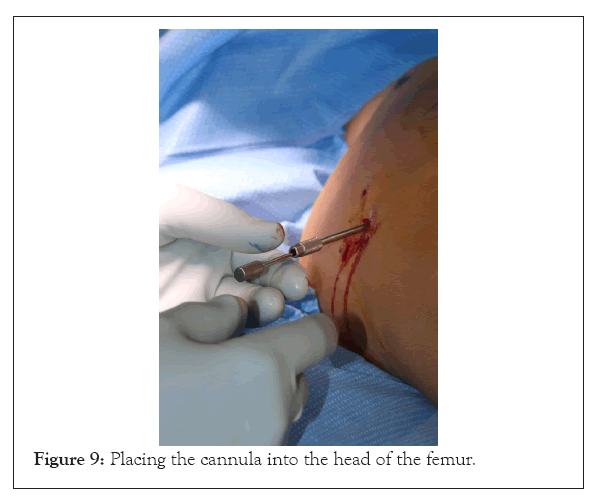 physical-medicine-femur