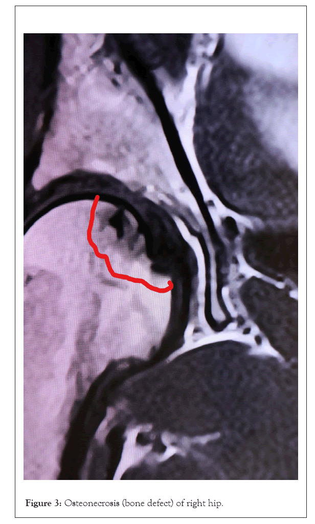 physical-medicine-osteonecrosis