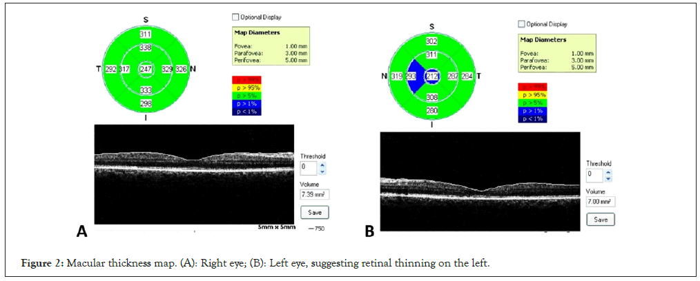 Macular