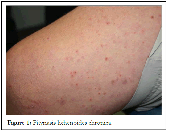 JCTR-Pityriasis