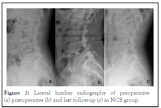 JCTR-lumbar