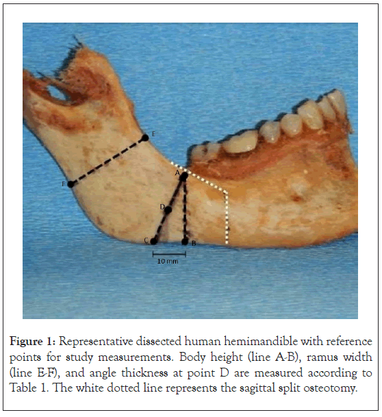 hemimandible