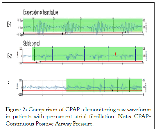 telemonitoring