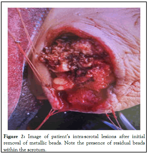 CPOA-lesions