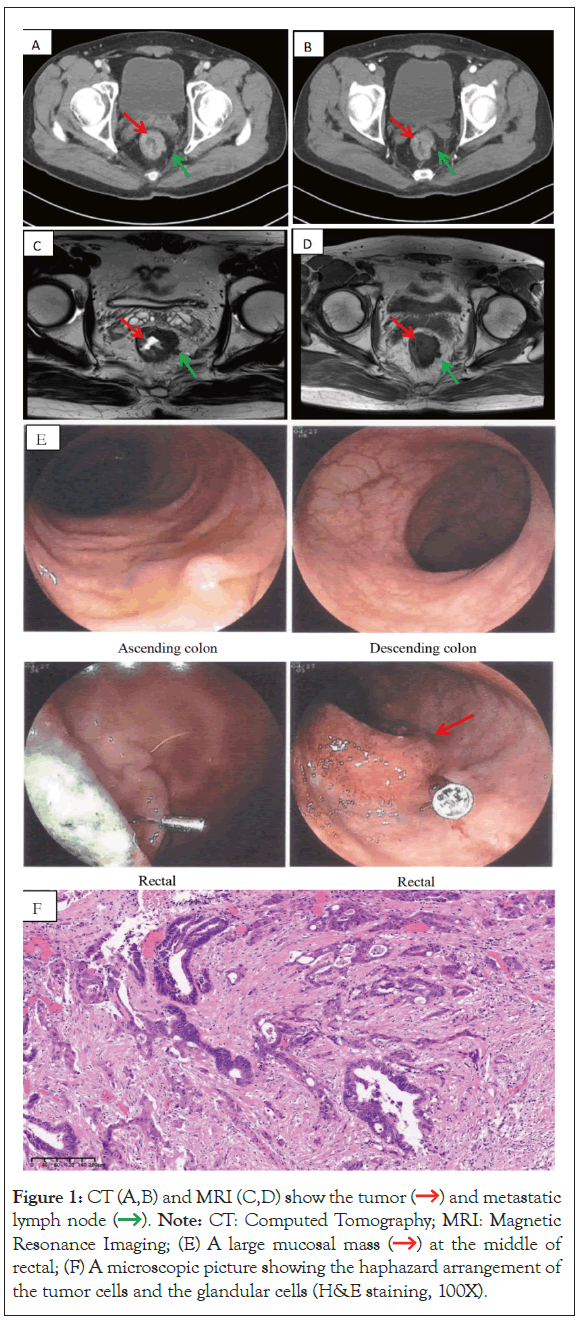 tumor