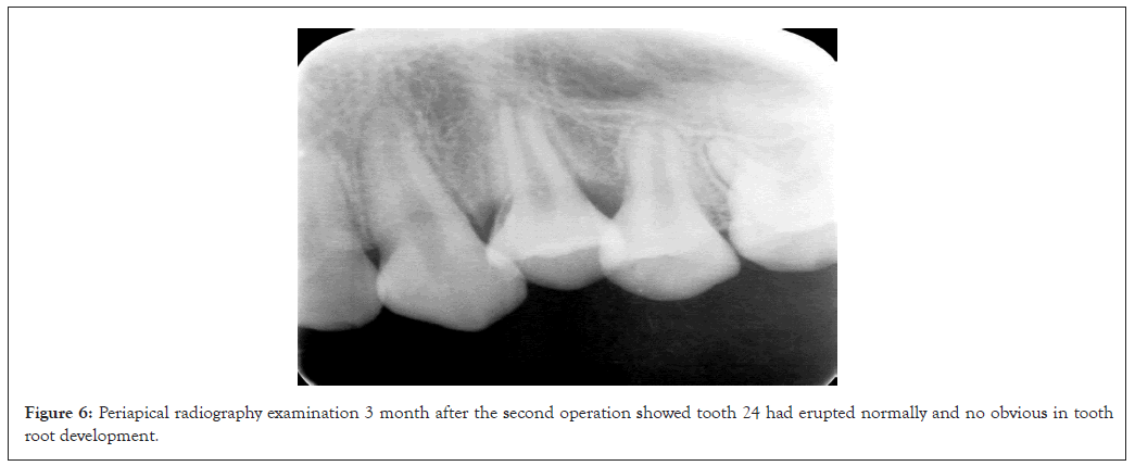 Periapical