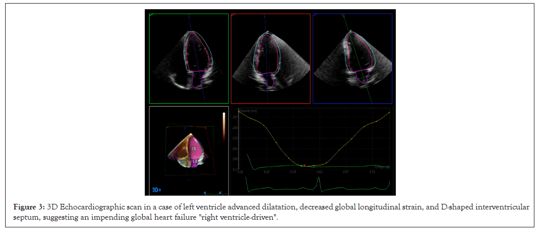 dilatation