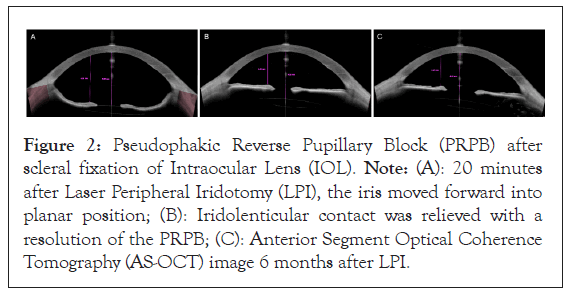 Intraocular