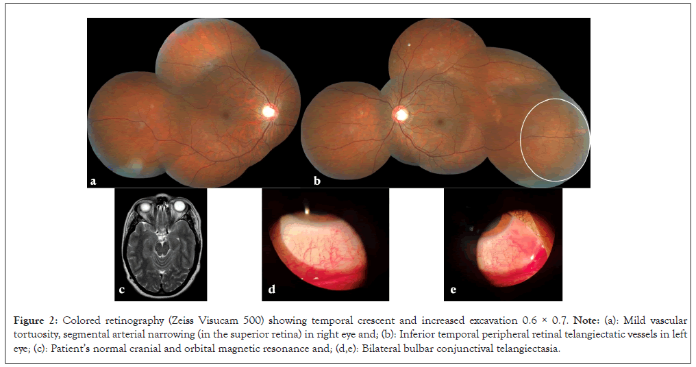 retinography