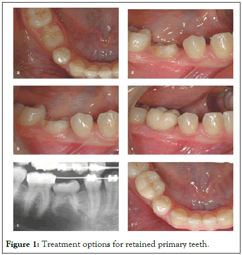 PTCR-primary