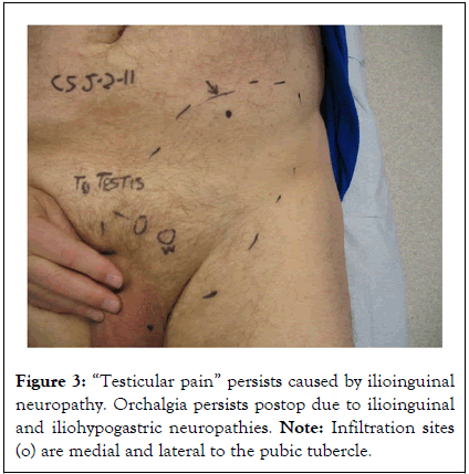 andrology-ilioinguinal