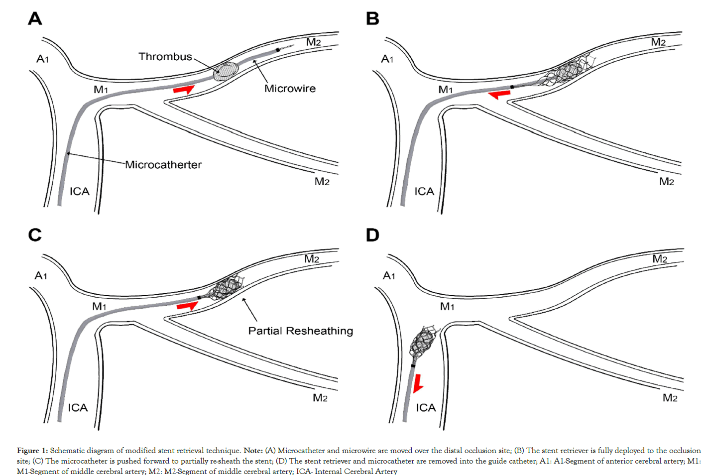 Microcatheter