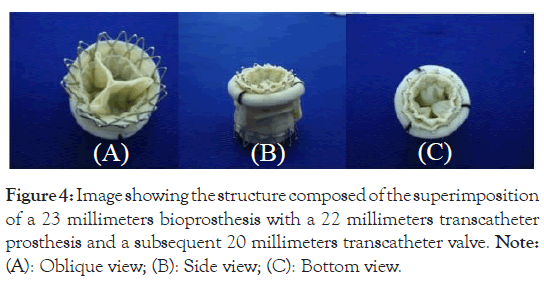 prosthesis