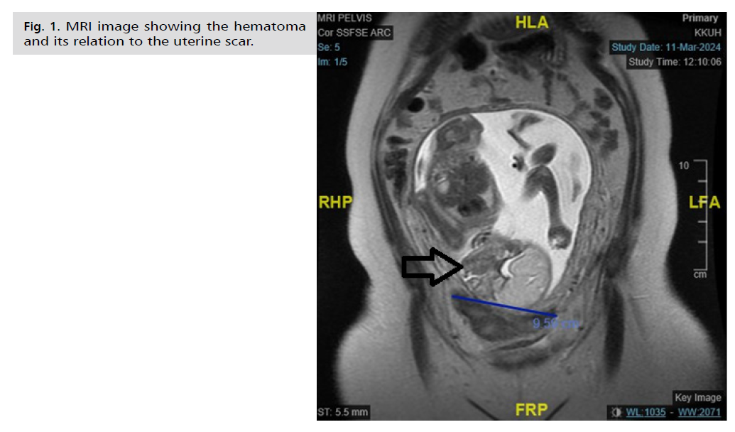 ginekologia-hematoma