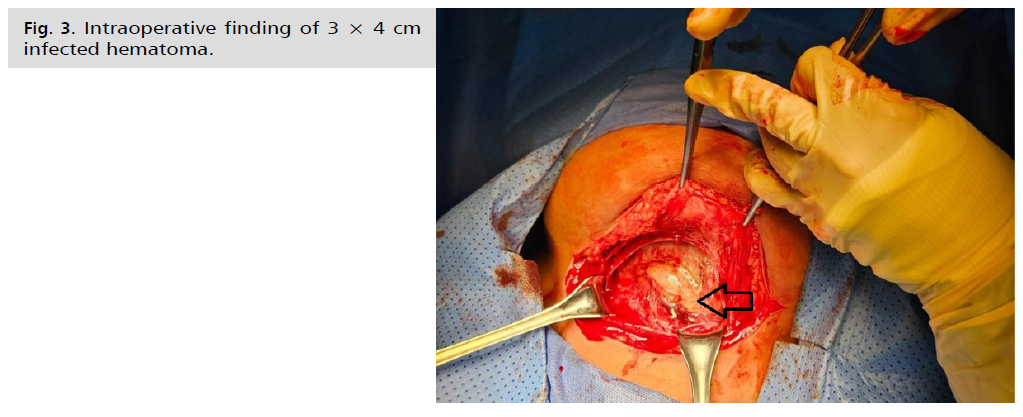 ginekologia-hematoma