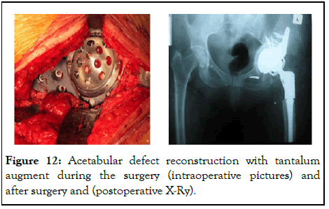 omcr-Acetabular