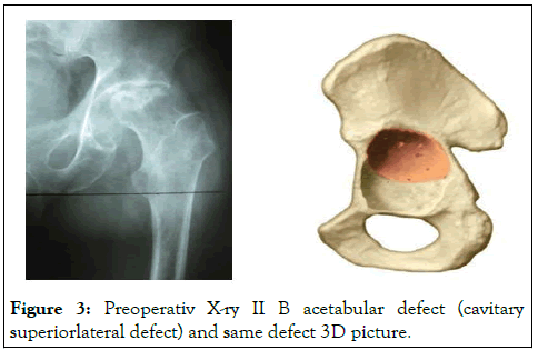 omcr-acetabular