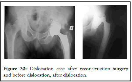 omcr-dislocation