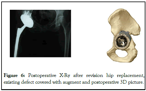 omcr-hip