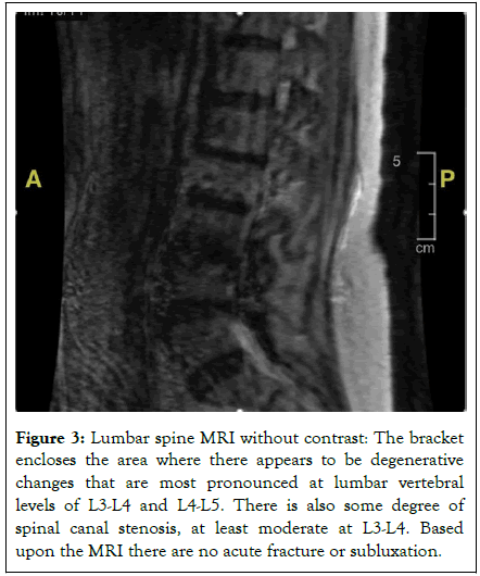 fracture