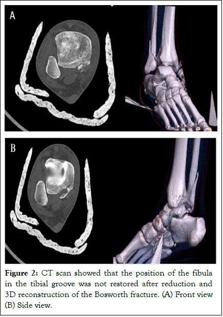 physical-medicine-tibial