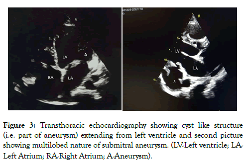 angiolog-left-ventricle