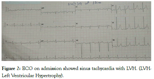 angiolog-sinus-tachycardia