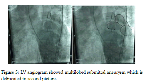 angiolog-submitral-aneurysm