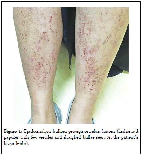 clinical-experimental-dermatology-bullosa