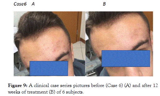 Efficacy And Tolerability Of A Tretinoin 0 02 Clindamycin 0 8 And Glycolic Acid 4 Gel In Acne A Multicenter Prospective Pragmatic Assessor Blinded 12 Week Trial On 159 Subjects