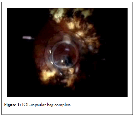 clinical-experimental-ophthalmology-capsular