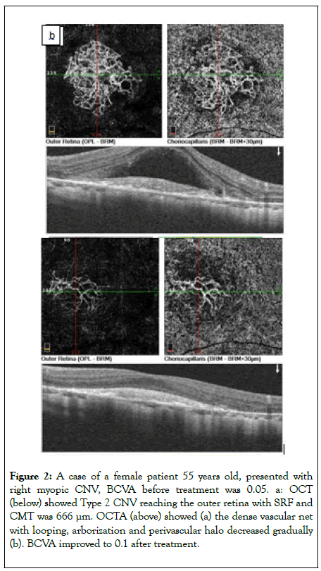 clinical-experimental-ophthalmology-halo