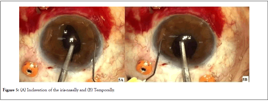 clinical-experimental-ophthalmology-nasally