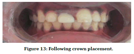medical-dental-science-crown-placement