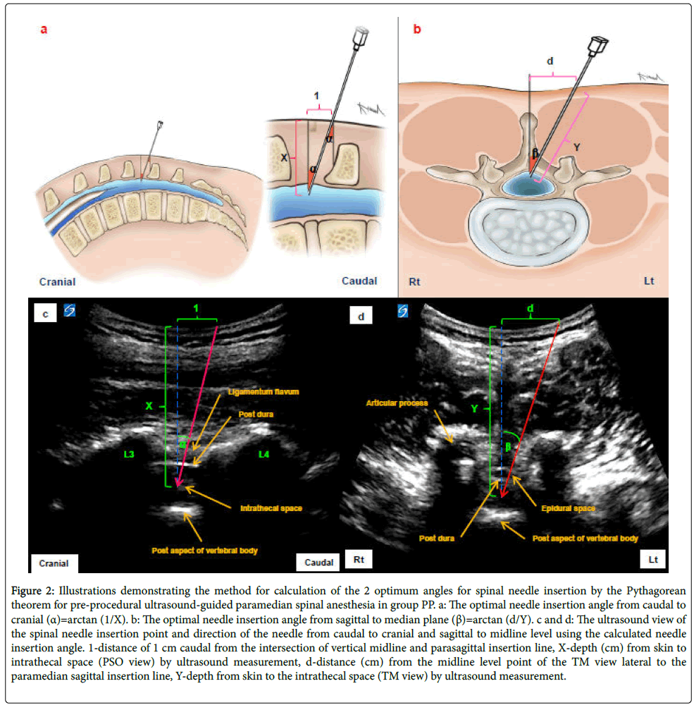 Anesthesia clinical research paramedian spinal