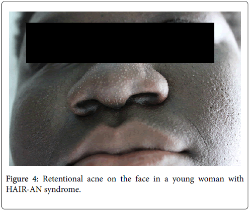 Hyperandrogenism insulin resistance and acanthosis nigricans HAIRAN  syndrome an extreme subphenotype of polycystic ovary syndrome  BMJ Case  Reports