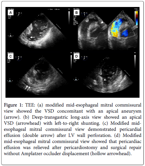 Transesophageal Echocardiogram - Garani Cardiac Centre