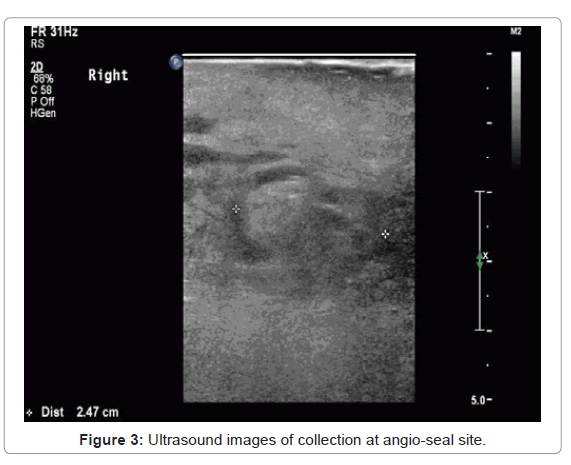 Vascular Closure Device: To Close or Not To Close?