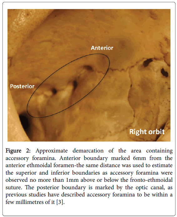 posterior ethmoidal foramen